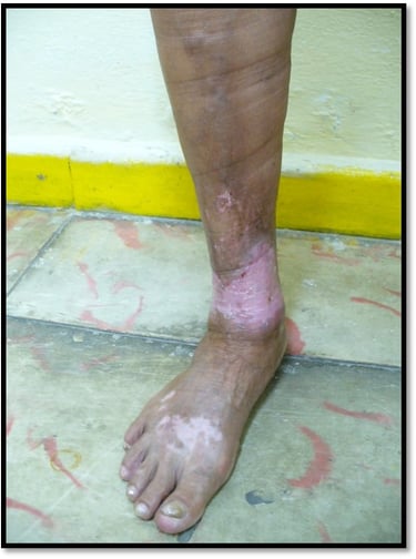 Despues del Tratamiento de Escleroterapia por el Dr. Antonio Suárez la ulcera cicatrizó