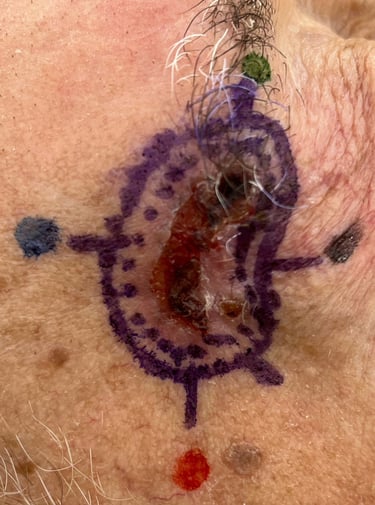 Marcação tumor para confecção mapa, Cirurgia Micrográfica de Mohs em Salvador, Bahia