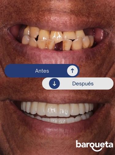 Caso de éxito de coronas dentales en nuestra clínica dental en sevilla