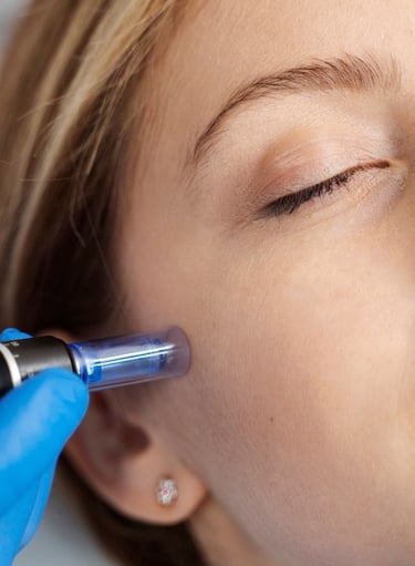 Microneedling mit SkinPen im Aesthetik Atelier Bochum für glattere Haut