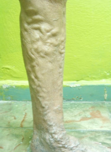 Pierna con varices tronculares