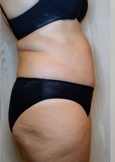 Fianchi e addome DOPO del Trattamento Lipolite Corpo