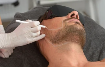 men face preperation for laser beard definition have laser protection on eye and therapis drow with white pencil aria to do t