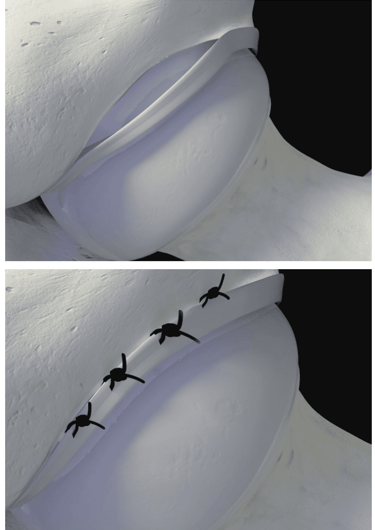 Artroscopia do quadril: sutura do labrum acetabular.