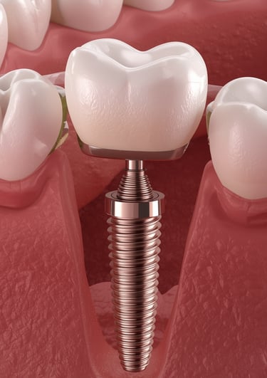 Implante dental de titanio integrado en hueso maxilar con corona dental - Clínica DUPRINS Lima