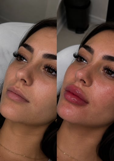 Ray Aesthetics dermal fillers treatment