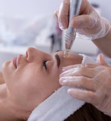 Ray Aesthetics microneedling procedure