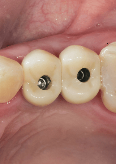 Dental crowns and bridges as restorative dental care solutions to strengthen teeth and replace missi