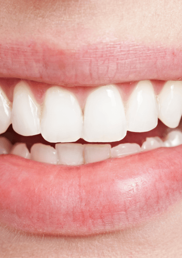Dentist applying resin to a chipped tooth during a cosmetic bonding procedure.