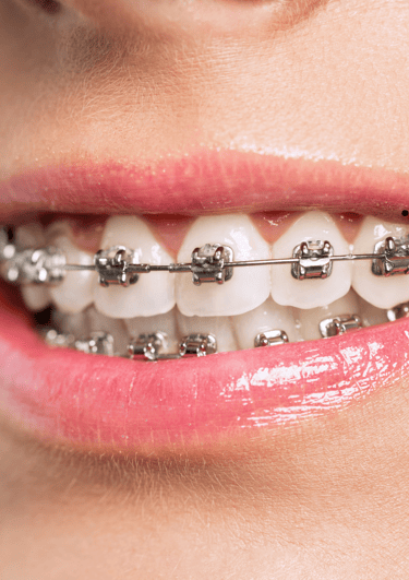 Teeth with traditional metal braces, showing durable and time-tested orthodontic care