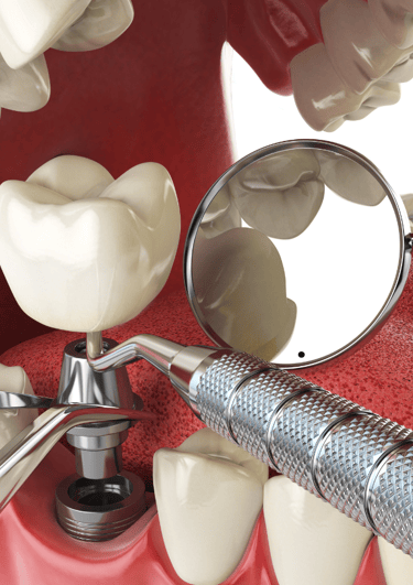 Close-up of a dental implant being placed into the jawbone during oral surgery
