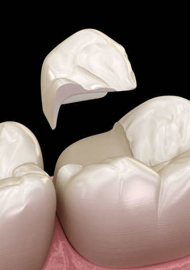 Dentist repairing a chipped tooth using dental bonding material in a clinical setting