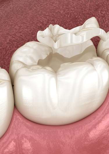 Dental professional fitting a replacement crown on a patient’s tooth after crown loss