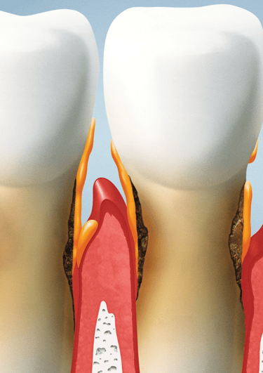 Close-up of a patient receiving professional gum disease treatment to restore oral health.