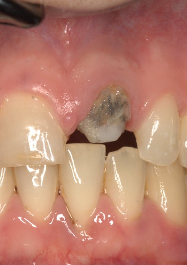 Preparazione Moncone Incongrua