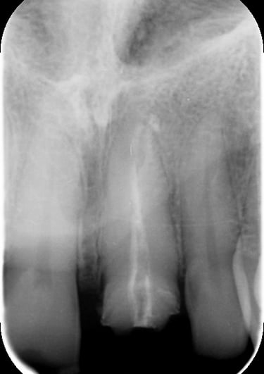 Trattamento Canalare Incongruo