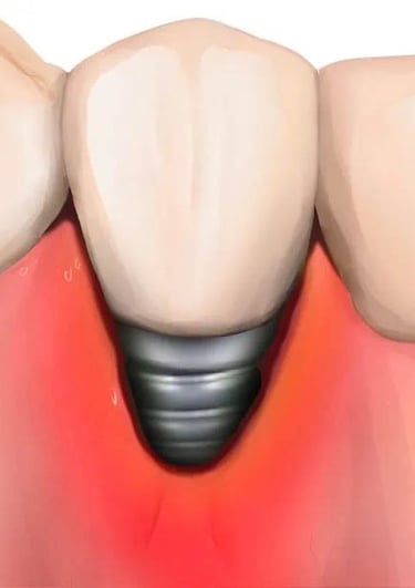 peri-implantitis risk loss dental implant hygiene-precision.com