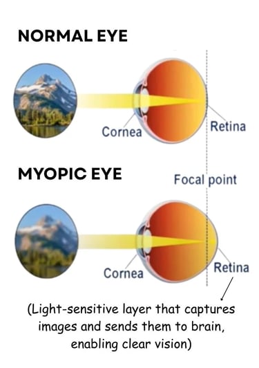 Illustration of focal point of normal and myopic eye explaining about what is myopia