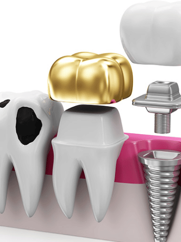 restorative dental procedures
