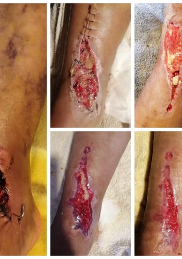 Una progresión de las etapas de cicatrización de heridas quirúrgicas y recuperación de úlceras.