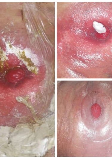 colostomia ileostomia estomas curacion educacion estomas