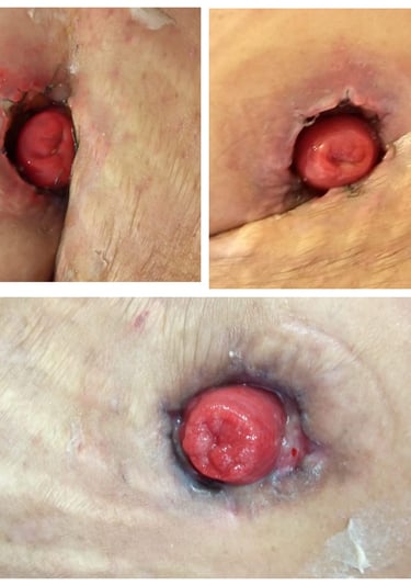 colostomía ileostomía estoma de eliminacion complicación quirúrgica