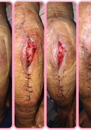 dehiscencia de herida quirurgica curacion de heridas cicatrizacion