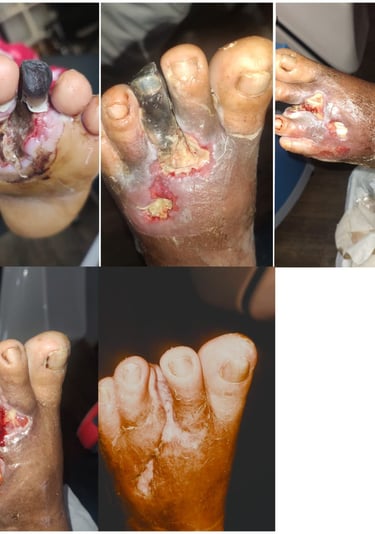 Curacion avanzada de heridas pie diabético necrosis ulceras