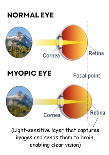 Illustration of focal point of normal and myopic eye explaining about what is myopia