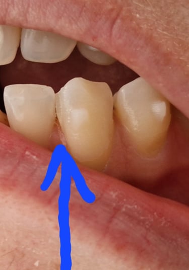 mit invisalign attachments