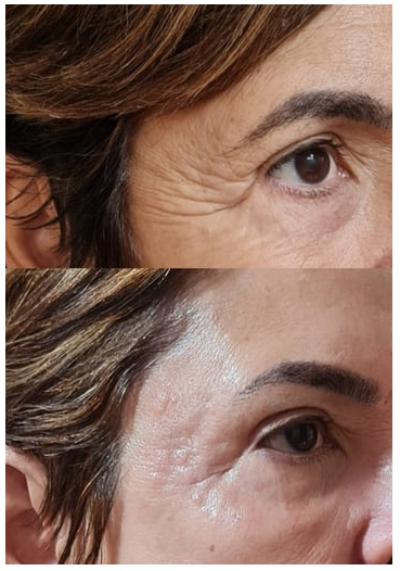 botox bh