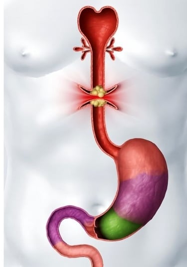 vomiting and obstructions in the upper gastrointestinal tract 