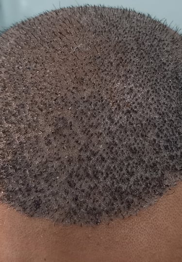 Hair transplant, hair fall, hair regrowth, hair transplant surgeon, hair transplant in peshawar