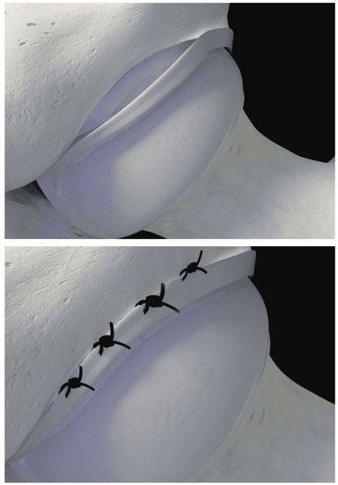 Artroscopia do quadril: sutura do labrum acetabular.