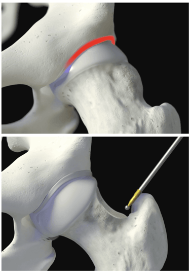 Artroscopia do quadril: tratamento do impacto cam