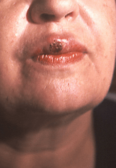 პირველადი სიფილისი - ორალური შანკრი - samedicino-targmani.ge