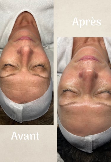 visage de femme avant et après un soin anti-âge réalisé par Nathalie Gaullier