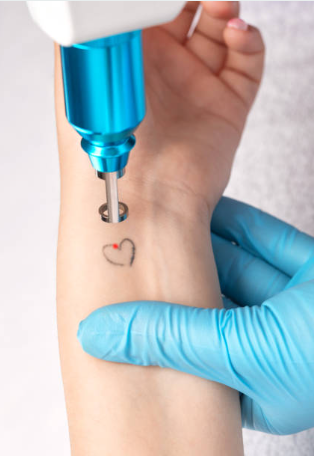 Remoção de tatuagem a laser