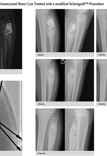 MRI-aneurysmal-bone-cyst-fibula-sclerograft.jpg