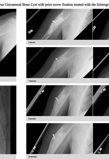 xray-unicameral-bone-cyst-humerus-prior-surgery-sclerograft.jpg