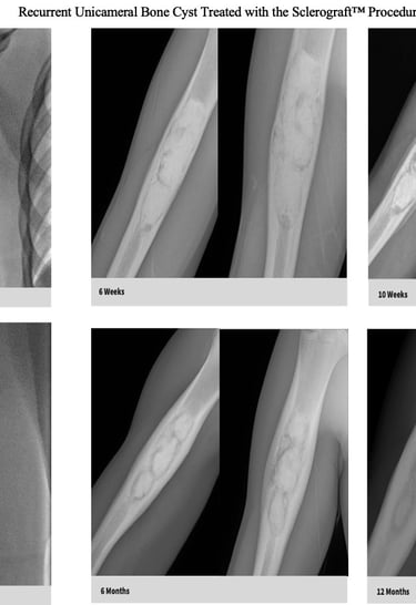 xray-unicameral-bone-cyst-humerus-recurrence-sclerograft.jpg
