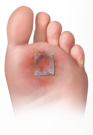 Restorigin amniotic membrane on a foot ulcer