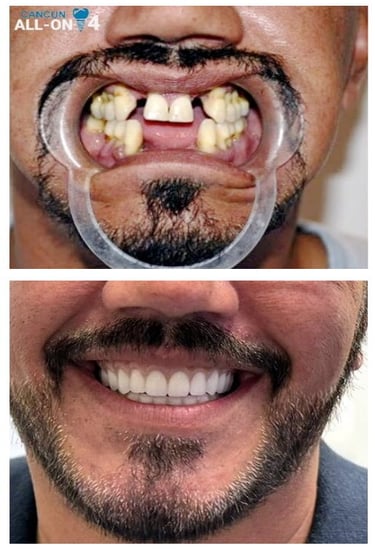 All on 4 full mouth restoration in Cancun