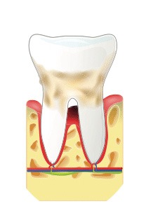 Parodontie médecine jet dentaire ozone hygiene-precision