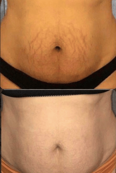 a woman's abdomen before and after a tummying