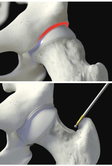Artroscopia do quadril: tratamento do impacto cam