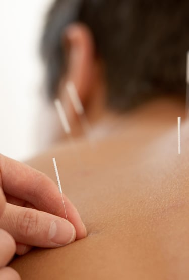 Acupuncture 