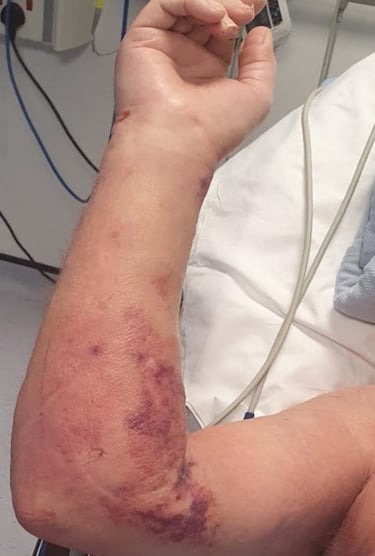 🦠 Flesh-Eating Disease (Necrotizing Fasciitis)