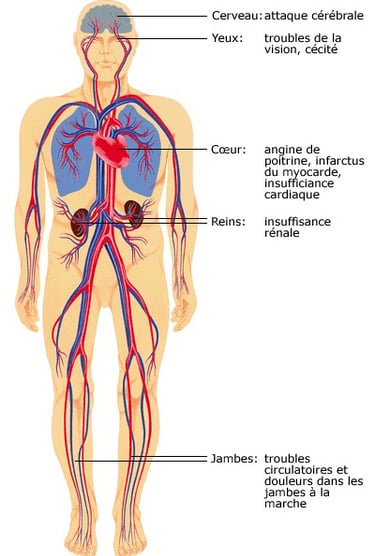 hypertension arterielle coach sportif amiens