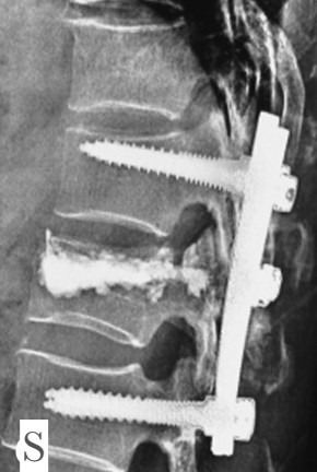 Dr Sivaraj, the best spine surgeon in Salem. treatment of spine fractures and spine trauma.